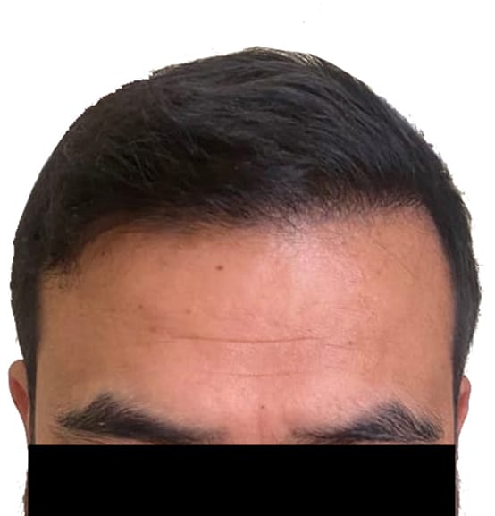 hair transplantation result