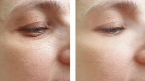 Close up of a woman's eye area in exosome therapy before and after result. Left side shows wrinkles and texture, right side appears smoother, tighten and more youthful.