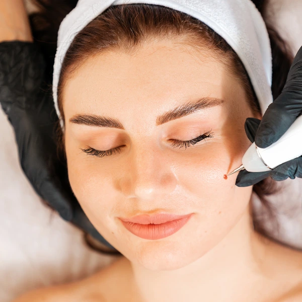 mole removal in nepal,kathmandu