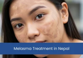 Melasma Treatment in Nepal