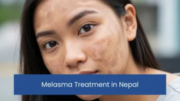 Melasma Treatment in Nepal
