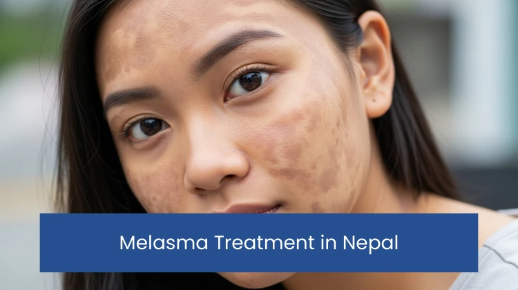 Melasma Treatment in Nepal