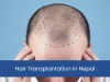 Hair Transplantation in Nepal