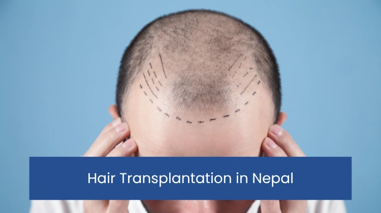 Hair Transplantation in Nepal
