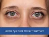 Under Eye Dark Circle Treatment