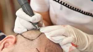 best hair transplant in kathmandu nepal
