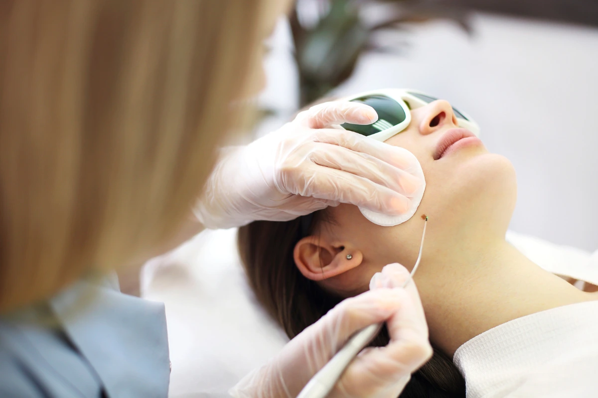 laser mole removal in nepal