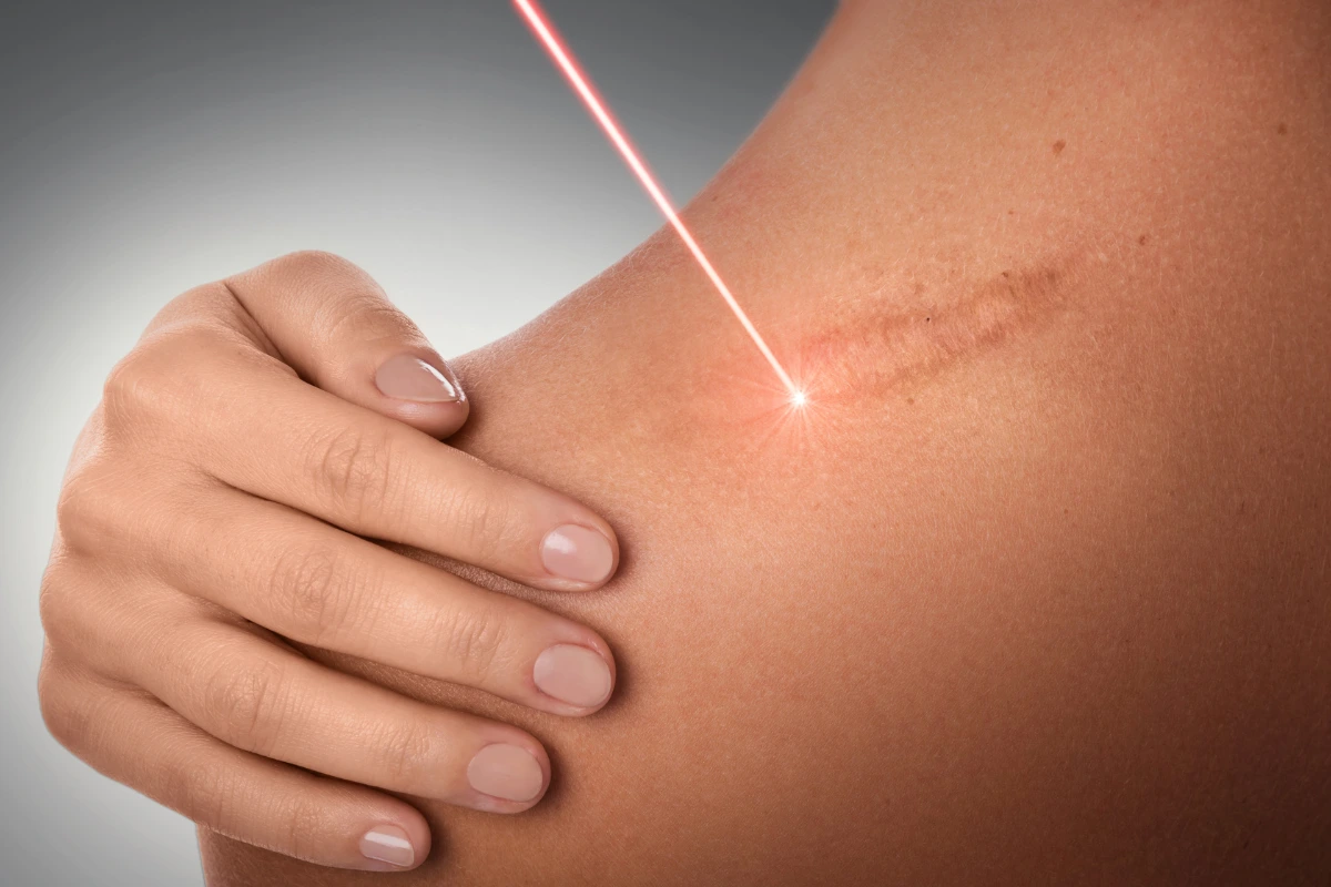 scar removal using laser
