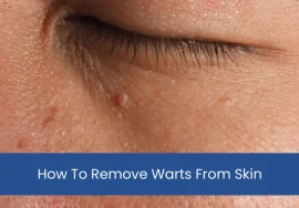 How To Remove Warts From Skin