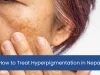 How to Treat Hyperpigmentation in Nepal