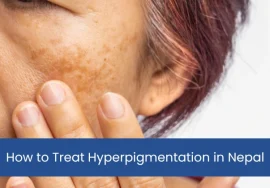 How to Treat Hyperpigmentation in Nepal