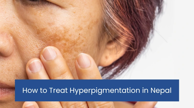 How to Treat Hyperpigmentation in Nepal