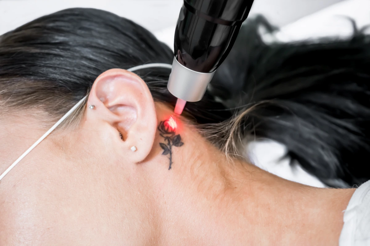 Laser Tattoo Removal in Nepal