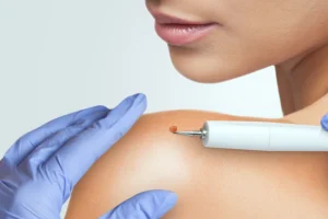 wart removal in nepal by laser therapy