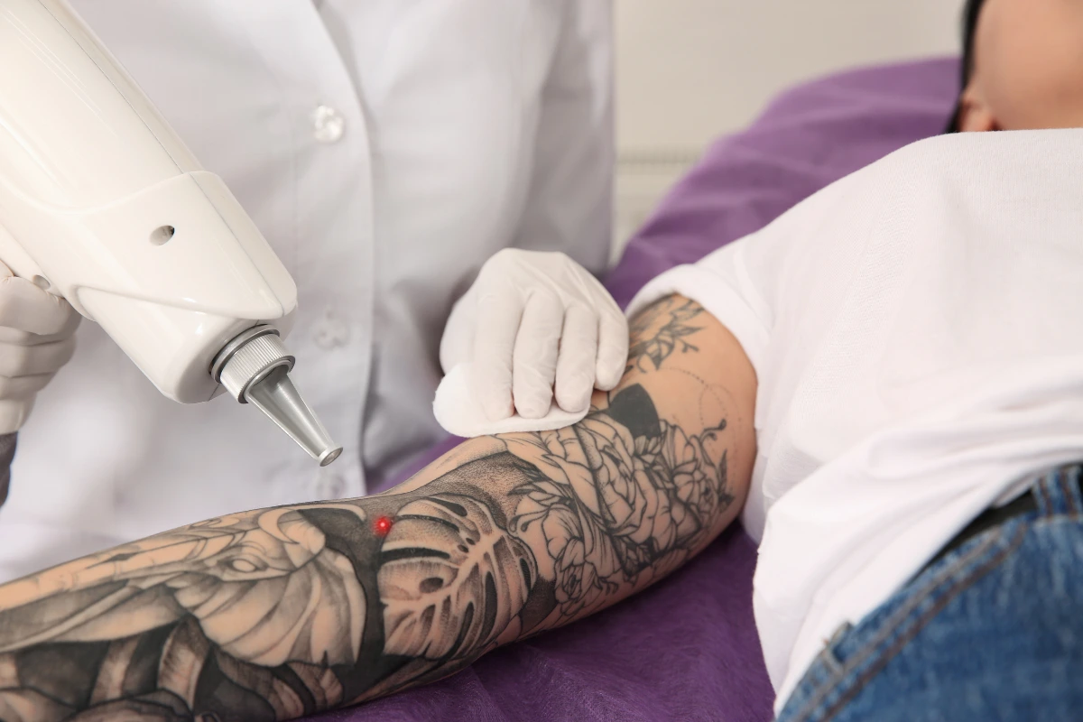laser tattoo removal in kathmandu nepal