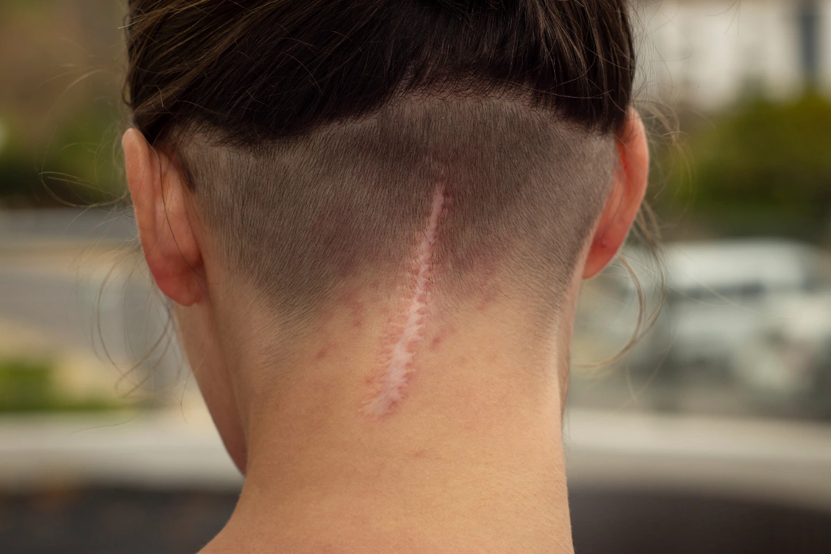 scars revision surgery in nepal