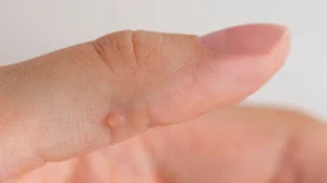 wart on hand