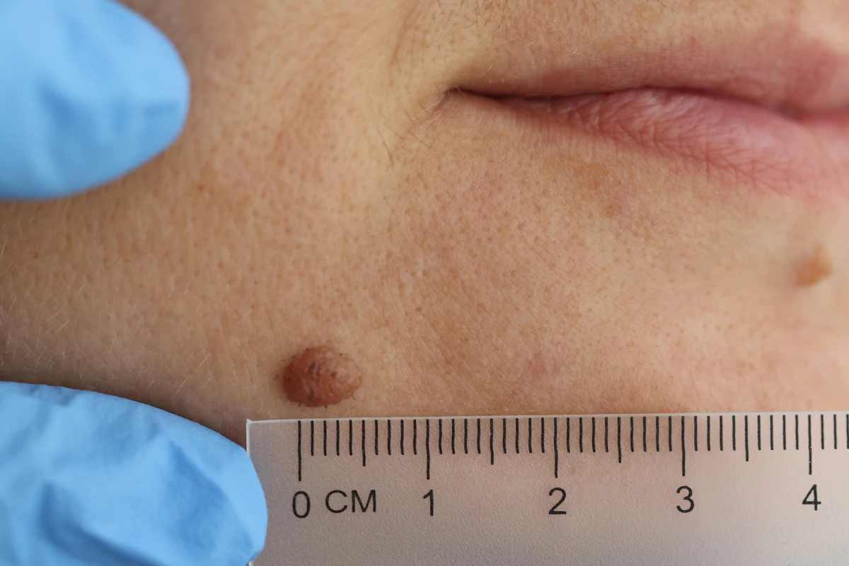 warts removal in kathmandu nepal