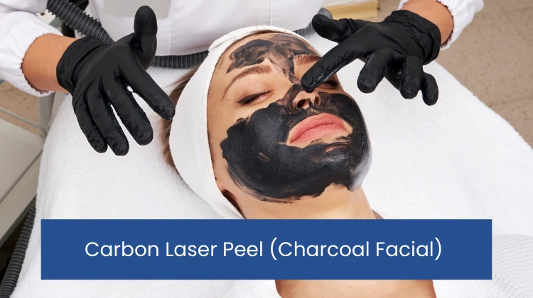 Charcoal Facial or Carbon Laser Peel in kathmandu