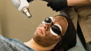 carbon face peeling procedure in top skin clinic in kathmandu