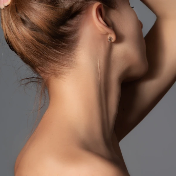 girl during scar revison treatment in kathmandu