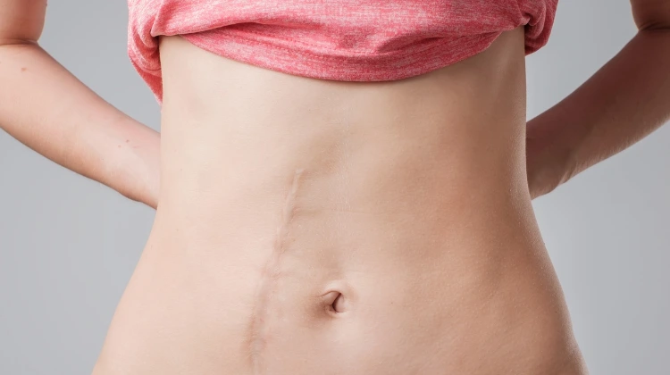 girl with scars in her belly