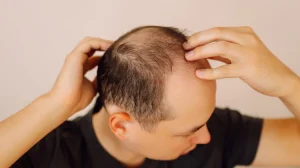 hair loss in men 