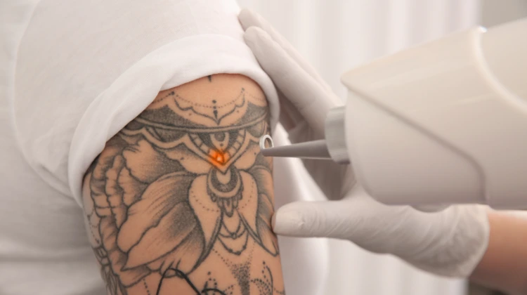 laser tattoo removal cost in nepal
