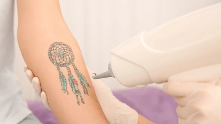 laser tattoo removal cost in nepal