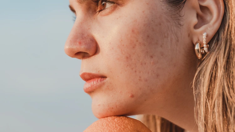 girl with acne scars in her face